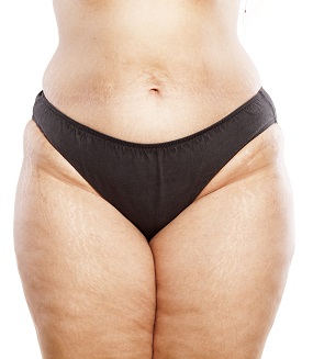 Diagnosing Lipedema: Know the symptoms. Find the Cure.