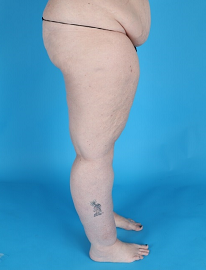 Lipedema before and after photos of Lipedema surgery results.