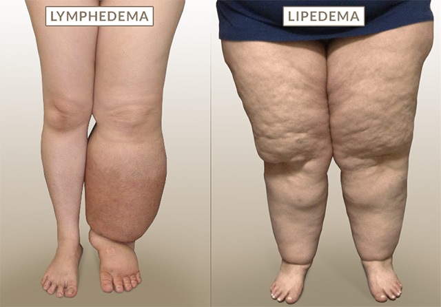 Diagnosing Lipedema 