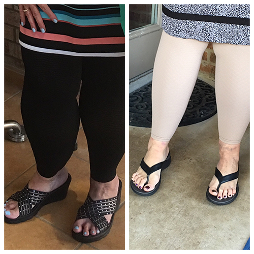 before and after photos of legs | lipedema liposuction