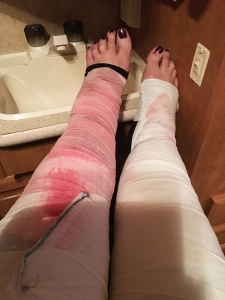 recovery | photo showing legs bandages after Lipedema surgery