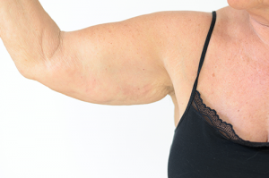 arm liposuction | photo of woman holding up her overweight arm