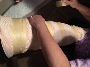 touch up lipedema surgery | photo of leg being bandaged