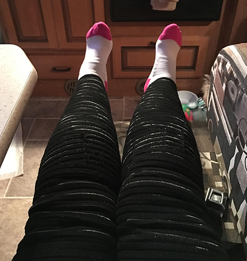 the genetic factor of Lipedema | photo of Denise's legs