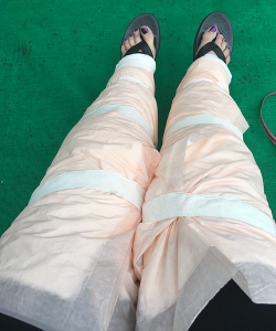 lipedema surgery recovery | photo of wrapped legs after surgery