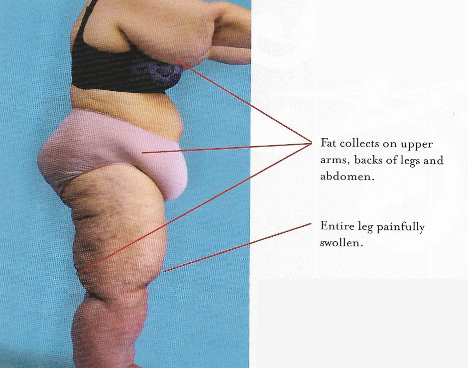 pierderea de grăsimi pe psmf femei de pierdere în greutate recenzii complete