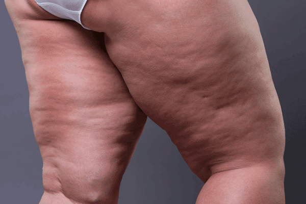 Cellulite or lipedema