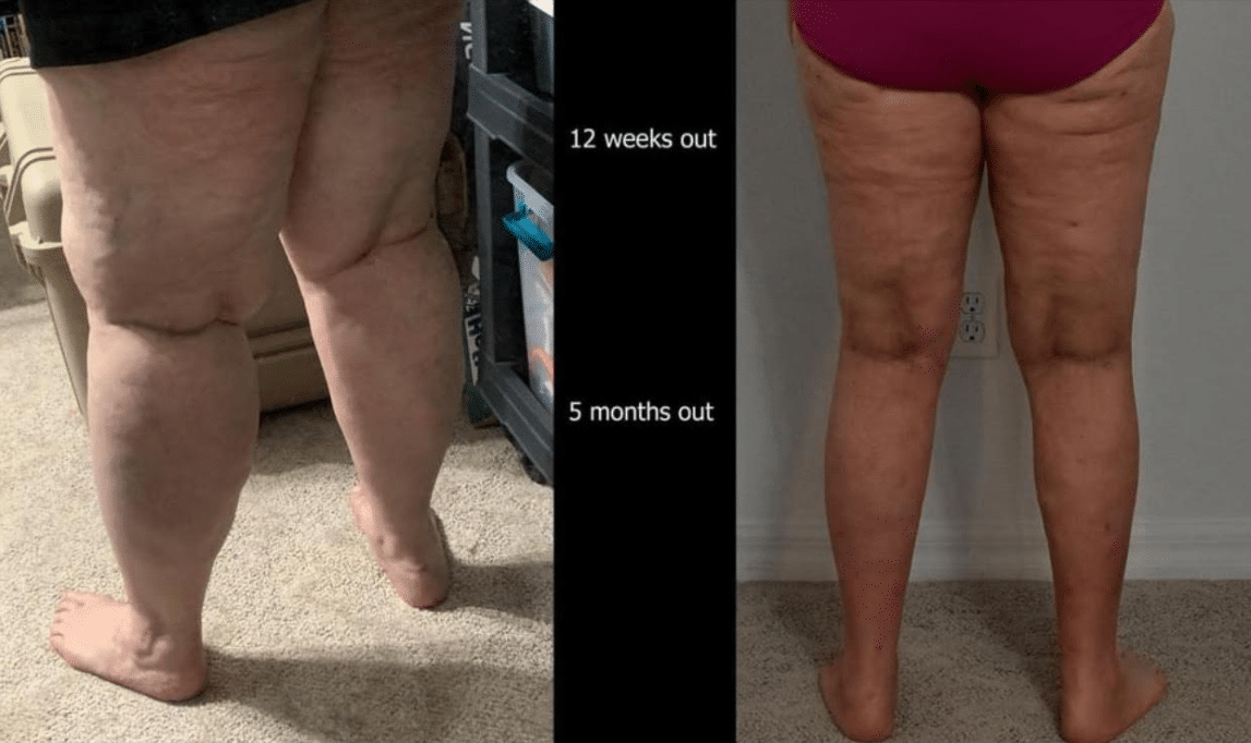 Lipedema Surgery Before and After Photos are actual patients.