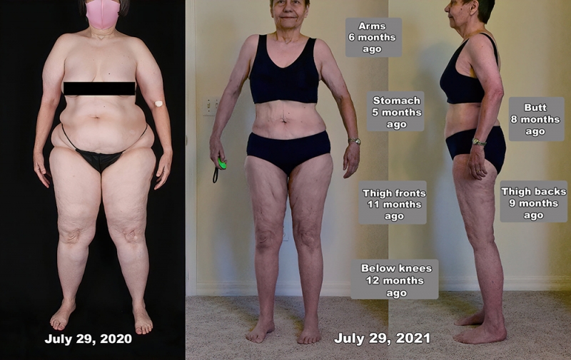 Lipedema Testimonials From Dr Marcia Byrd S Patients