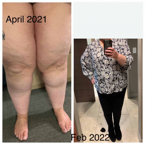 Exploring the Surgical Treatment of Lipedema with Lymphatic Sparing  Techniques : ObesityHelp