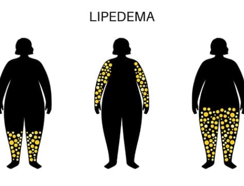 Is there a Link Between Obesity and Lipedema?