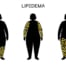 Link between obesity and lipedema