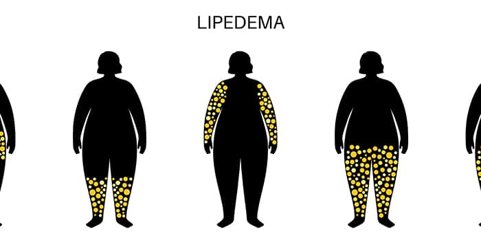 Link between obesity and lipedema