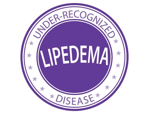 Misconceptions About Lipedema