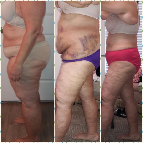 Lipedema Treatment With Liposuction Before After Photos