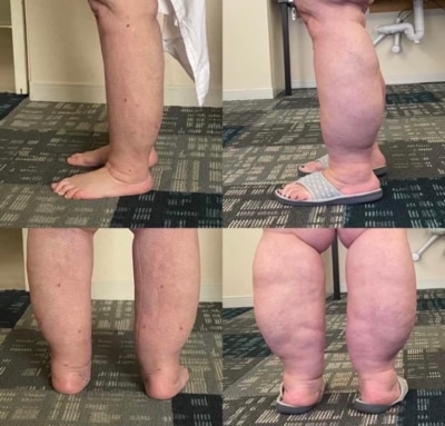 Lipedema in Lower Legs