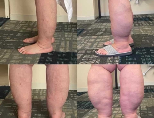 How Lipedema Affects the Lower Legs