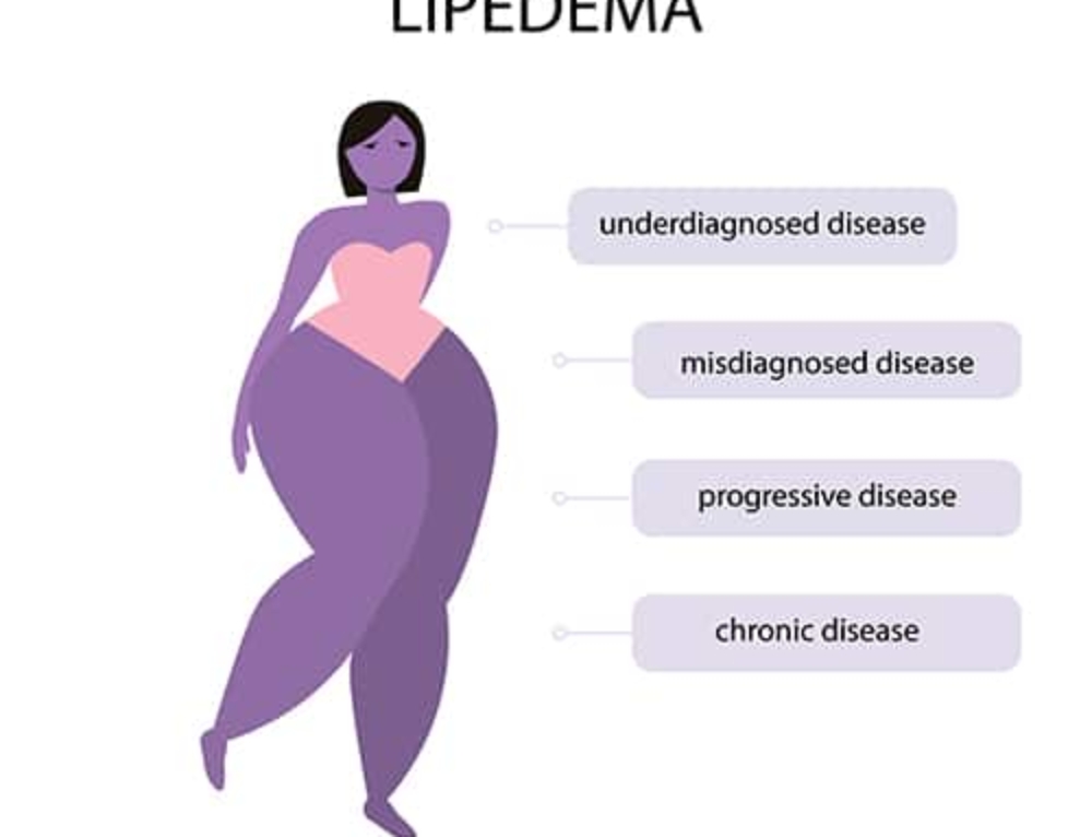 Causes Of Lipedema Are Not Comply Known.