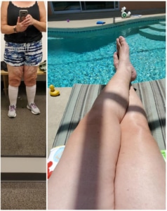 Lipedema Before and after pictures